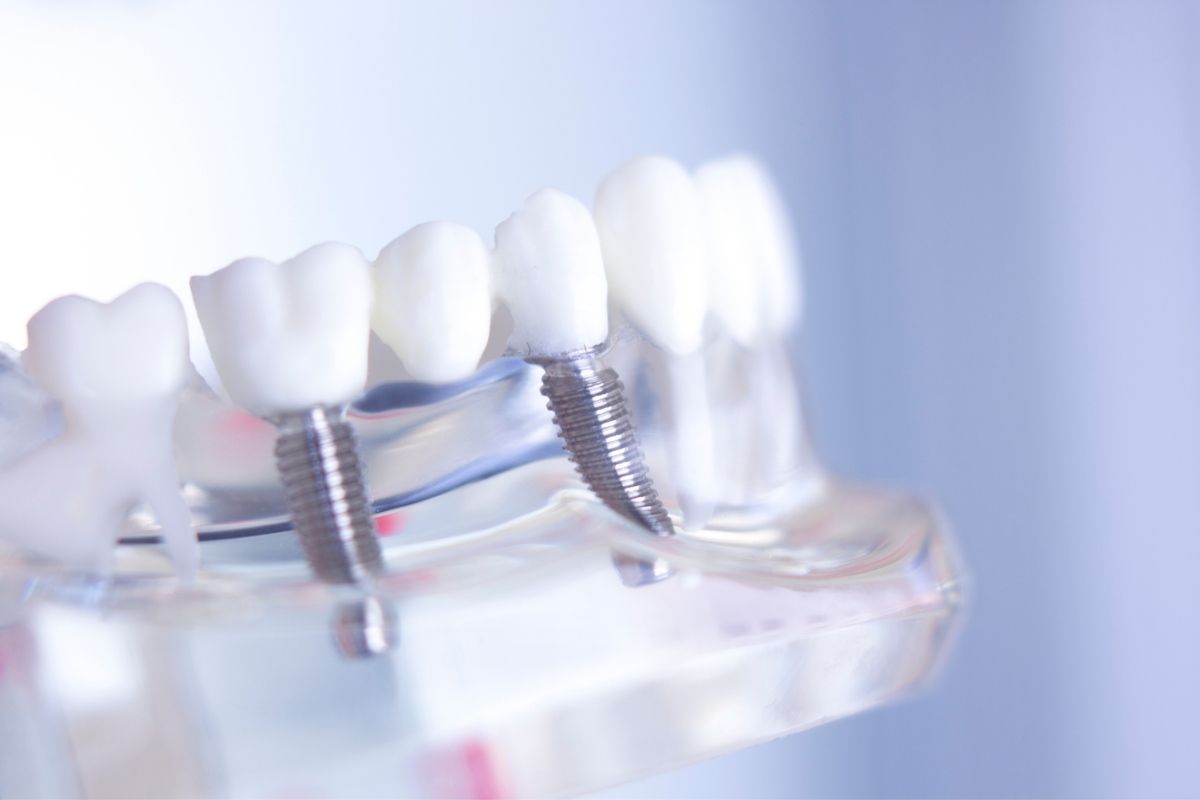 Prótesis Dental - Clínica Dental Prodental Santa Cruz