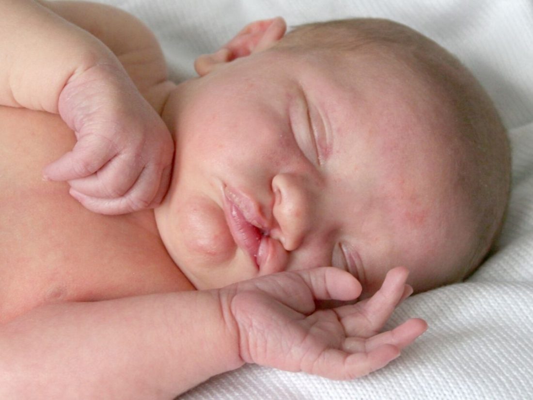 Labio leporino y paladar hendido en bebés: qué es y cómo se trata