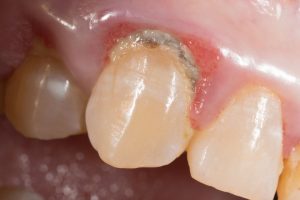 Cálculo dental: qué es y cómo se puede evitar