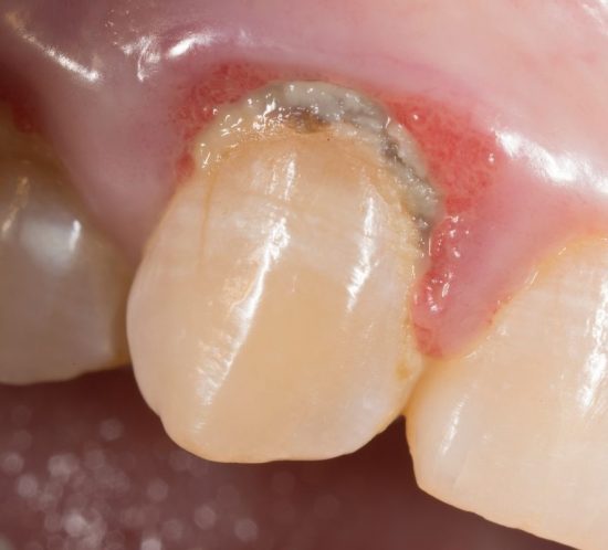 Cálculo dental: qué es y cómo se puede evitar - Clínica Dental Prodental Santa Cruz