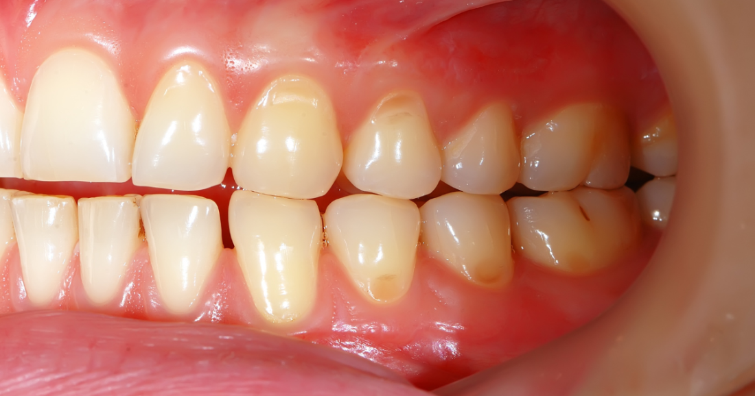 Manchas dentales: causas, tipos y cómo eliminarlas